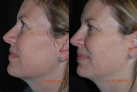 Ipl Nordlys Photofacial Palo Alto Ca Palo Alto Laser And Skin Care