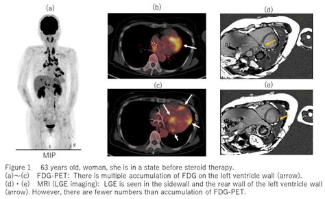 Utility Of FDG PET In Diagnosis And Monitoring Of Steroid Therapy In