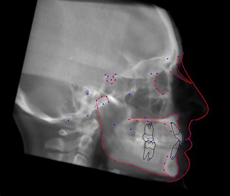 Cephalometric Analysis Based On Cbcts Cephx Ai Driven Dental