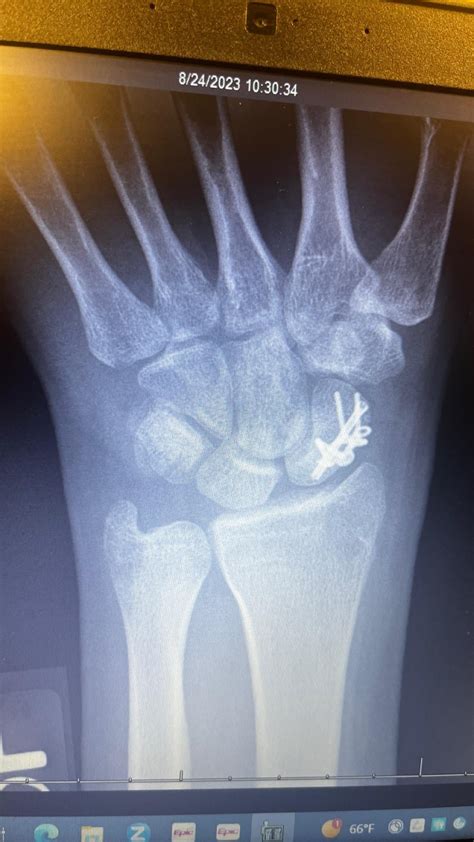 My scaphoid surgery : r/Radiology