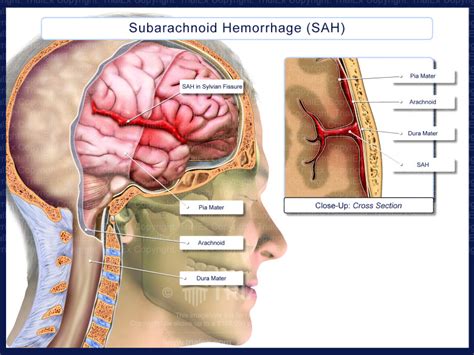 Subarachnoid Hemorrhage SAH TrialQuest Inc