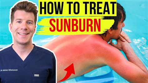 Doctor Explains How To Treat Sunburn Top Things To Do Avoid To