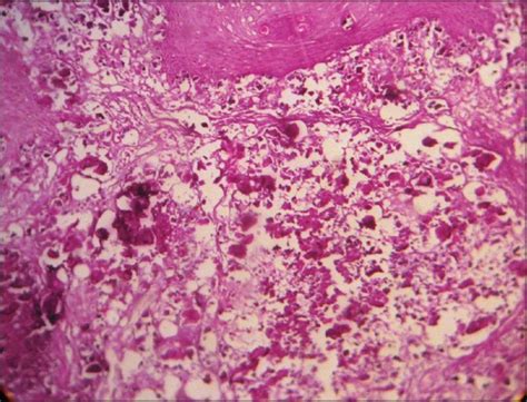 Calcified Keratoacanthoma With Tumoral Calcinosis In A 10 Year Old Boy