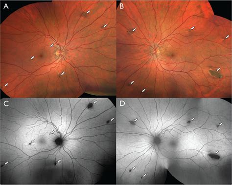 Pigmented Ocular Fundus Lesions Associated With Familial Adenomatous