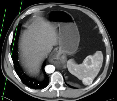 Lymphoepithelial Cyst Tail Of Pancreas And Splenic Hemangiomas