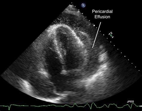 Pericardial Effusion Ultrasound