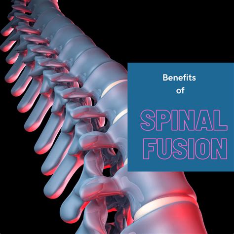 Benefits Of Spinal Fusion New Jersey Comprehensive Spine Care