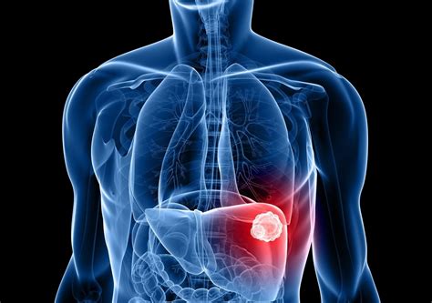 50 Facts About Liver Cancer