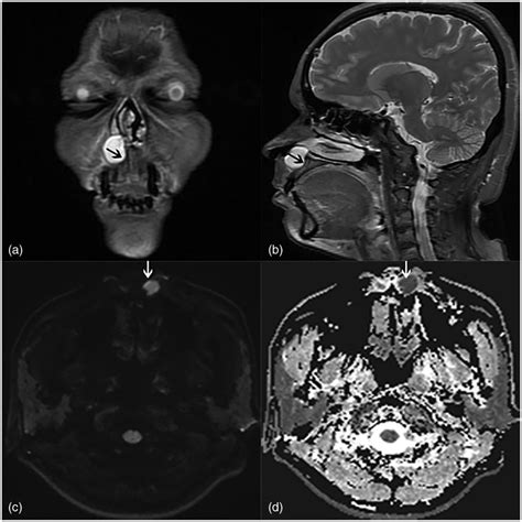 Coronal And Sagittal Magnetic Resonance Images Diffusion Weighted