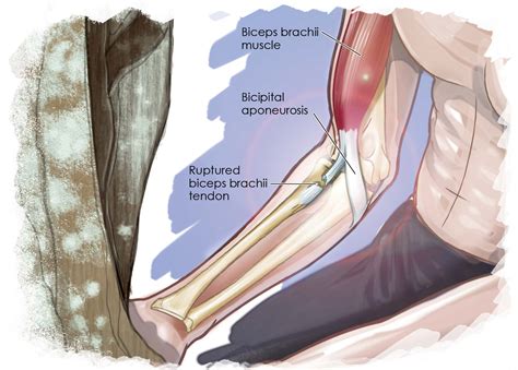 Bursting Biceps - Rock and Ice