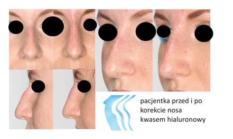 Archiwa Korekta Nosa Kwasem Hialuronowym Pozna Biogenica