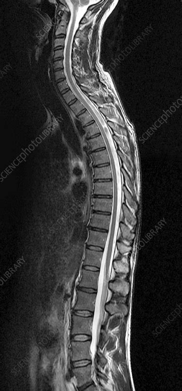 Mri Spine Anatomy Free Mri Lumbar Spine Sagittal Cross Off