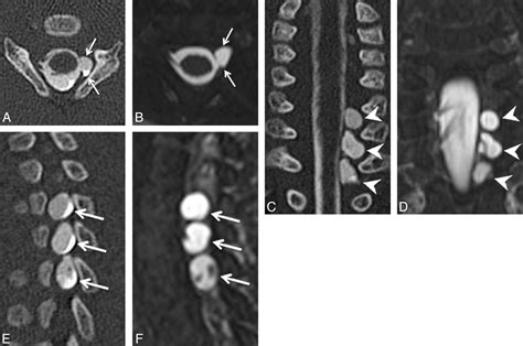 The Diagnostic Value Of CT Myelography MR Myelography And Both In