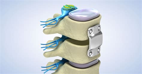 Extreme Lateral Interbody Fusion Xlif Atlanta Ga Spine Surgery