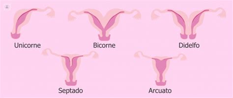 Malformaciones Uterinas qué es síntomas y tratamiento Top Doctors