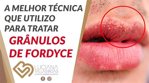 Gl Ndulas De Fordyce Genital Braincp