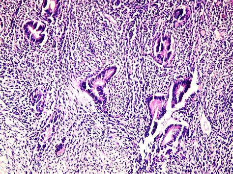 H and E STAINED IMAGE INDICATING a Disordered Proliferative Endometrium ...