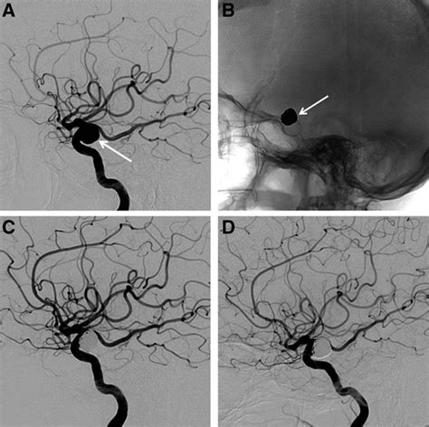 Endovascular Treatment Of Intracranial Aneurysms Stroke