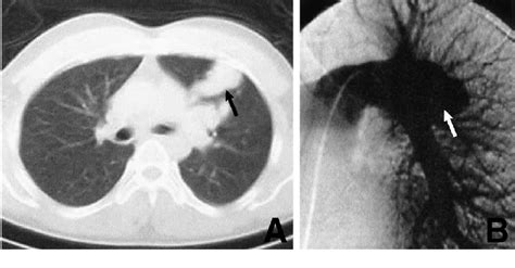 Chest Computed Tomography Scan With Contrast Medium A And Left Download Scientific Diagram