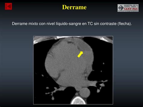 PPT Taponamiento cardíaco Causas y hallazgos radiológicos PowerPoint