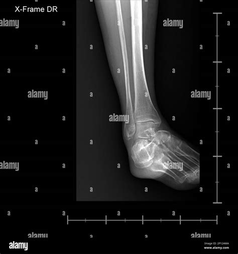 X-ray tarsal and ankle front Stock Photo - Alamy