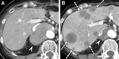 Liver Metastases Correlation Between Imaging Features And Pathomolecular Environments