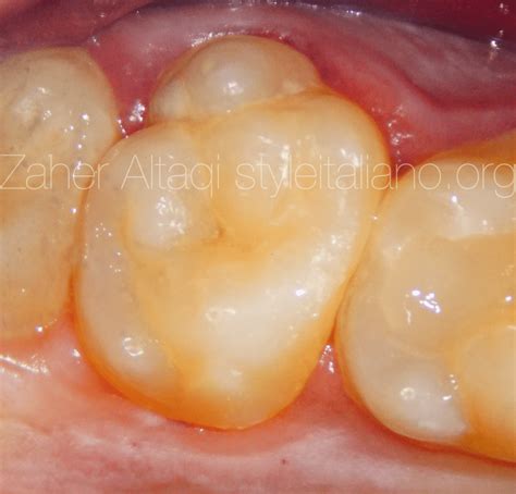 Unusual anatomy in upper second molar - Style Italiano Endodontics