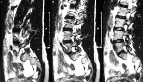 Anterior Sacral Meningocele Management In Gynecological Practice