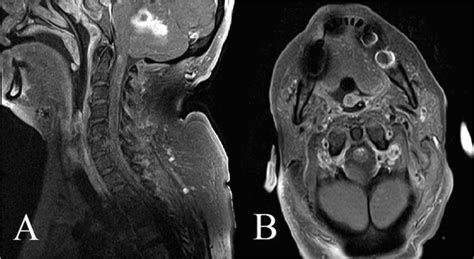 MRI cervical spine with contrast shows abnormal contrast-enhancing ...