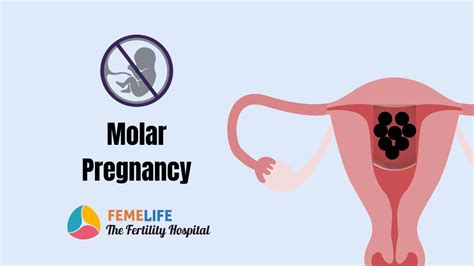 Molar Pregnancy Types Symptoms Causes Treatments 51 Off