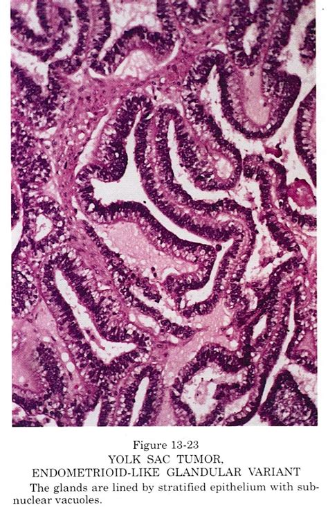 Pathology Outlines Yolk Sac Tumor