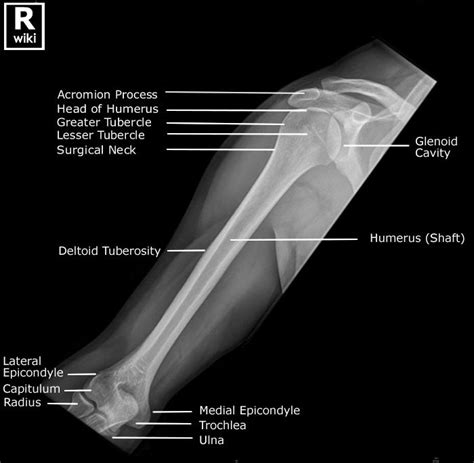 Radiographic Anatomy of the Humerus | Medical radiography, Radiology student, Radiology