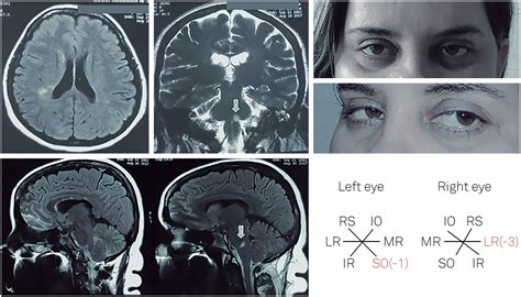 Teaching Brainstem Anatomy Using A Sharply Located Demyelinating Plaque Of Multiple Sclerosis