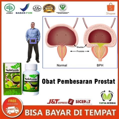 Jual Keloreena Obat Pembesaran Prostat Benign Prostatic Hyperplasia