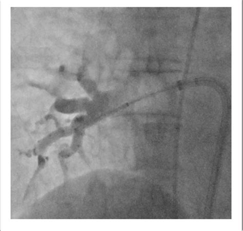 Figure 1 From Cryoballoon Ablation Of Atrial Fibrillation Without Demonstration Of Pulmonary