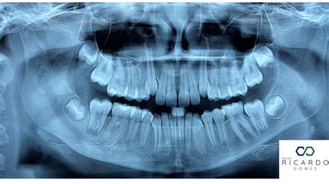 Osteomielite Crônica Primária Patologia Bucal