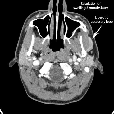 Parotid Sialogram Normal Iowa Head And Neck Protocols