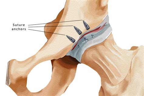 Treatment For Labral Tears David Slattery