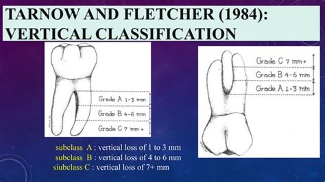 Furcation Involvement And Management Ppt