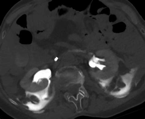 Bilateral Renal Forniceal Rupture Due To Retroperitoneal Hematoma After