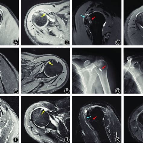 Preoperative And Postoperative Imaging Data For Each Case Case A