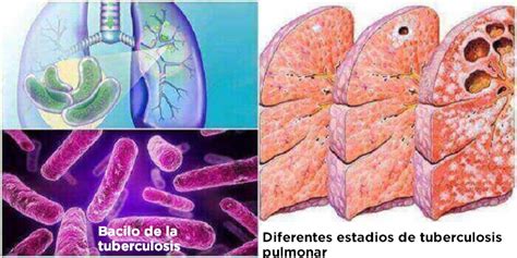 Tuberculosis