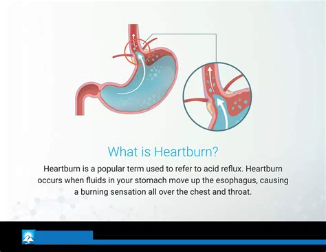 Heartburn Signs Symptoms And Treatment Options Ppt