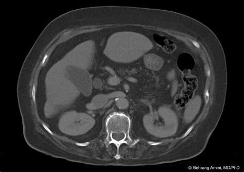 Roentgen Ray Reader: Fatty Replacement of the Pancreas