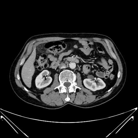 Focal Omental Infarction Radiology Case Radiopaedia Org