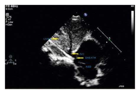 Optimization of echo views: (a) subcostal section shows the guidewire ...