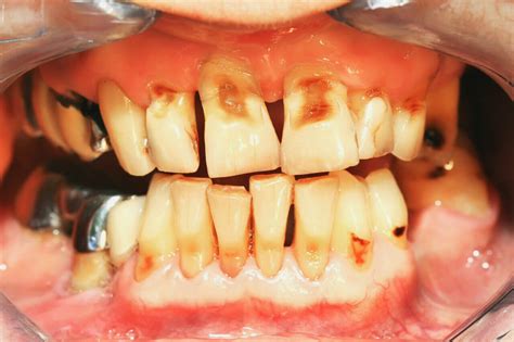 All You Need To Know About Tooth Decay In Kids Medical Blogs For Student