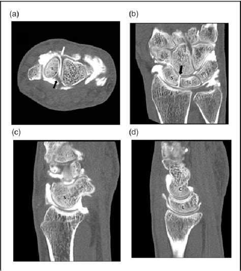 Isolated Injury Of The Dorsal Scapholunate Ligament Caused By