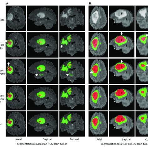 An Example Of Brain Tumor Segmentation Result And The Associated