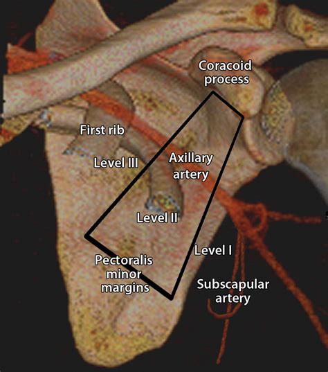 Axillary Staging Of Breast Cancer What The Radiologist Should Know Radiographics